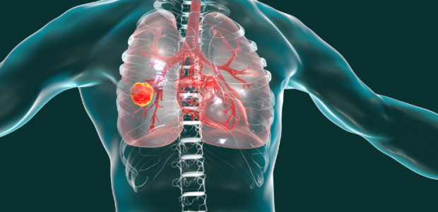 lung cancer cure market trends